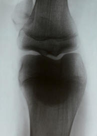 cartilages du genou