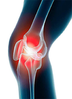 arthrose et inflammation articulaire