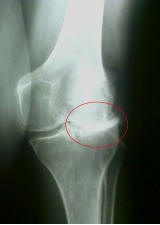 radiographie articulation arthrosique