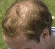 perte de cheveux alopecie