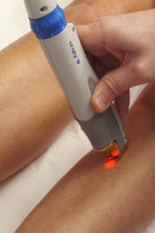 épilation definitive laser