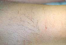 picioarele maro în varicoza tratamentul cu verticoza i tromboflebita