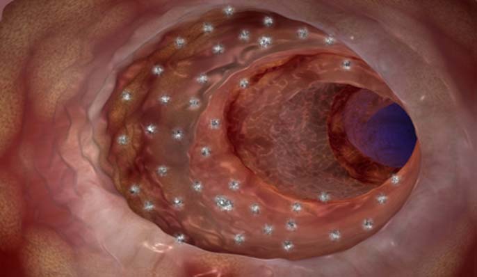 leaky-gut Intestin poreux ou leaky gut