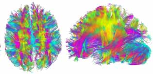 cerveau en IRM